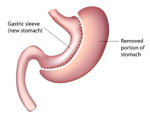Schéma d'une sleeve gastrectomie